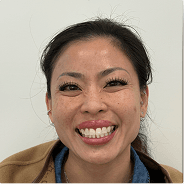 After treatment — open bite case, 14 months