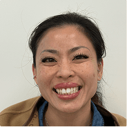 Before treatment — open bite case, 14 months